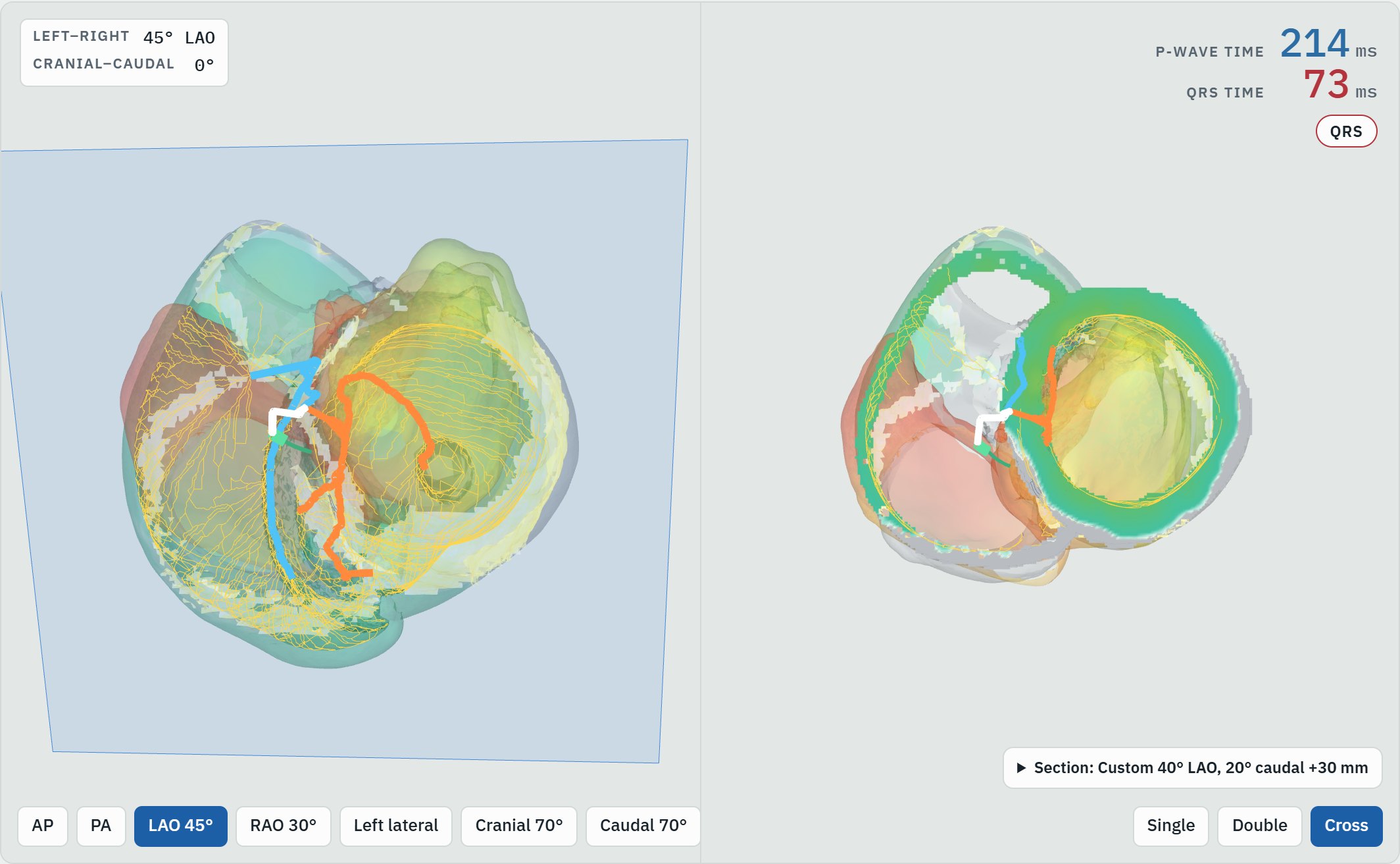 The viewer's Cross layout: on the left the whole heart in a 45-degree LAO view with the His bundle, bundle branches and Purkinje network drawn over translucent chamber walls and a blue frame marking the cutting plane; on the right the section through both ventricles, the wall colored green where the wavefront has passed.